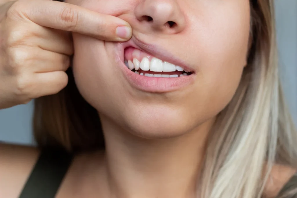 Patient avec une récession par greffe gingivale au Cabinet Almé.