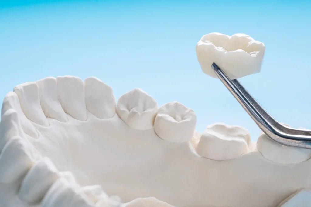 Couronne dentaire en céramique biocompatible prête à être posée au Cabinet Almé.